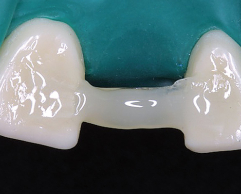 Everstick til krone og bro og fiberforsterkning og perio splinting