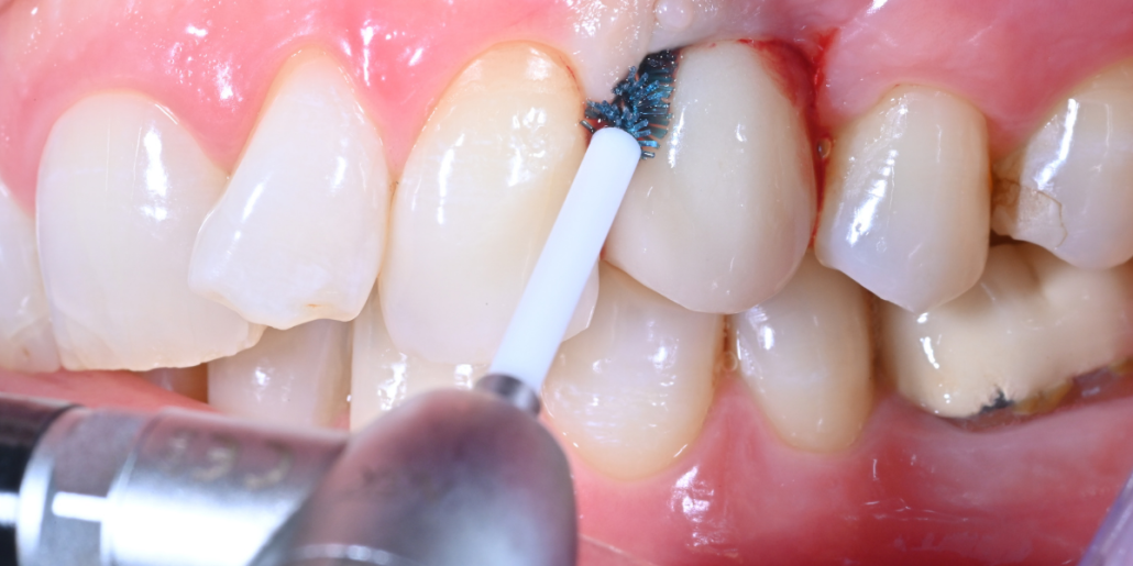 Labrida Bioclean i bruk